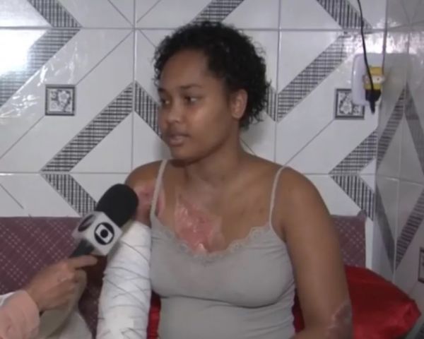 Jovem que teve corpo queimado enquanto cozinhava com álcool na BA pede ajuda para custear tratamento