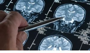 Dia Mundial do Alzheimer: 4 coisas que aprendemos nos últimos 4 anos