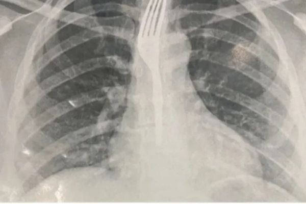 Mulher engole garfo durante refei&ccedil;&atilde;o em Guanambi