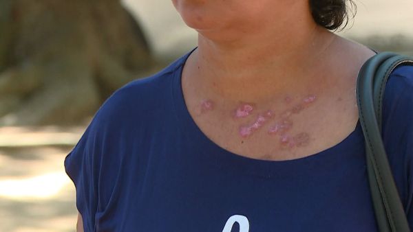 Manchas na pele? Saiba o que cada cor pode significar e quais casos merecem mais aten&ccedil;&atilde;o