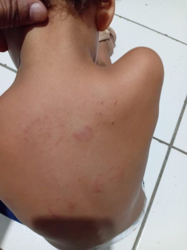 Guanambi: Criança é mordida 9 vezes dentro de creche